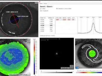 Еволюція та розвиток хірургії катаракти: платформа MS39-OSIRIS CSO